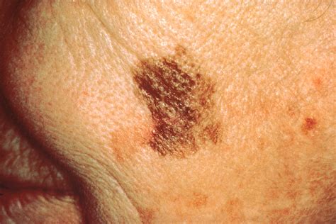 melanoma on skin pictures